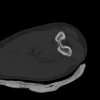 SPORK, NICO - 22.03.1976 - 02.08.2022 - CT obere Extremität - 18:02:23